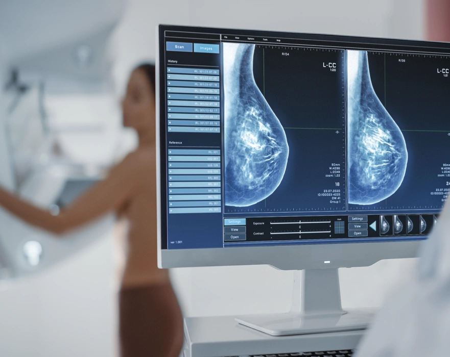 Computer screen displaying digital mammogram x-ray scans of breasts during a screening procedure.