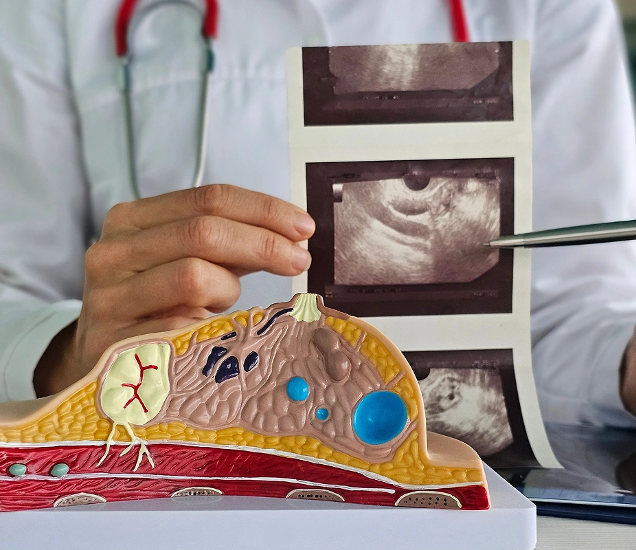 A doctor pointing to a breast ultrasound scan alongside a cross-section anatomical model during a breast cancer treatment planning consultation.