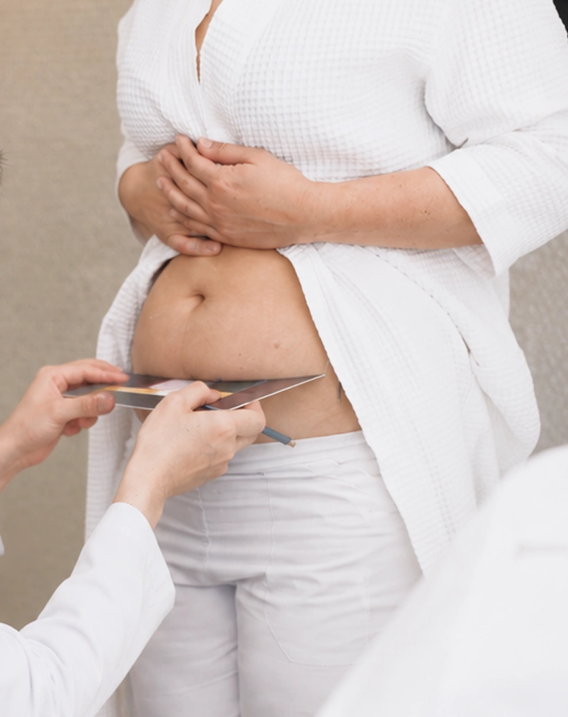Doctor using a ruler tool and surgical pencil to measure and mark a patient's lower abdomen during a consultation.