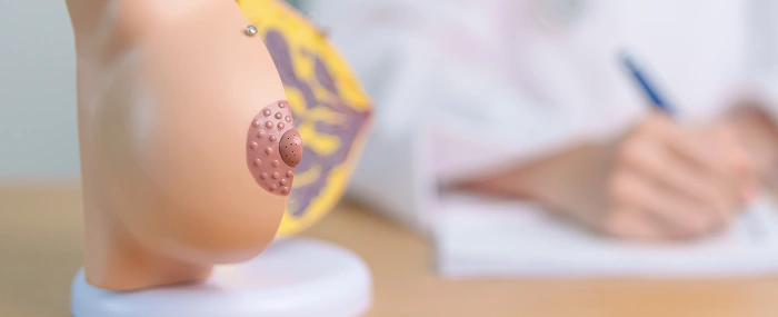 Close-up of an anatomical breast model used to explain nipple sensory preservation techniques during mastectomy.