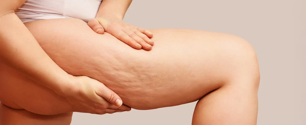 Woman touching upper leg showing cellulite and stretch marks.